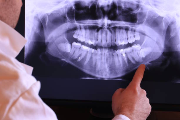 Best Emergency Dentist for Lost Fillings or Crowns in Port Vue, PA